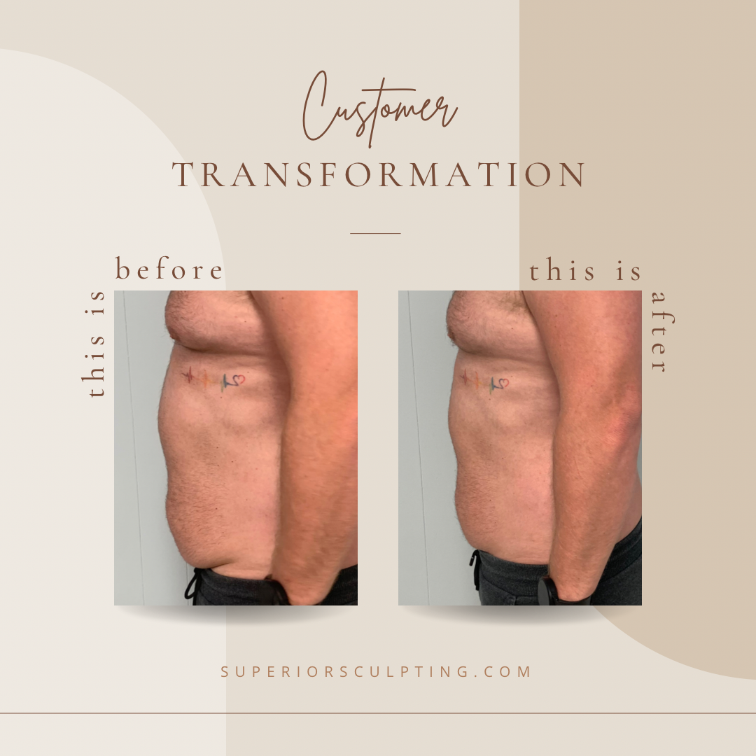 Roseland body sculpting before and after