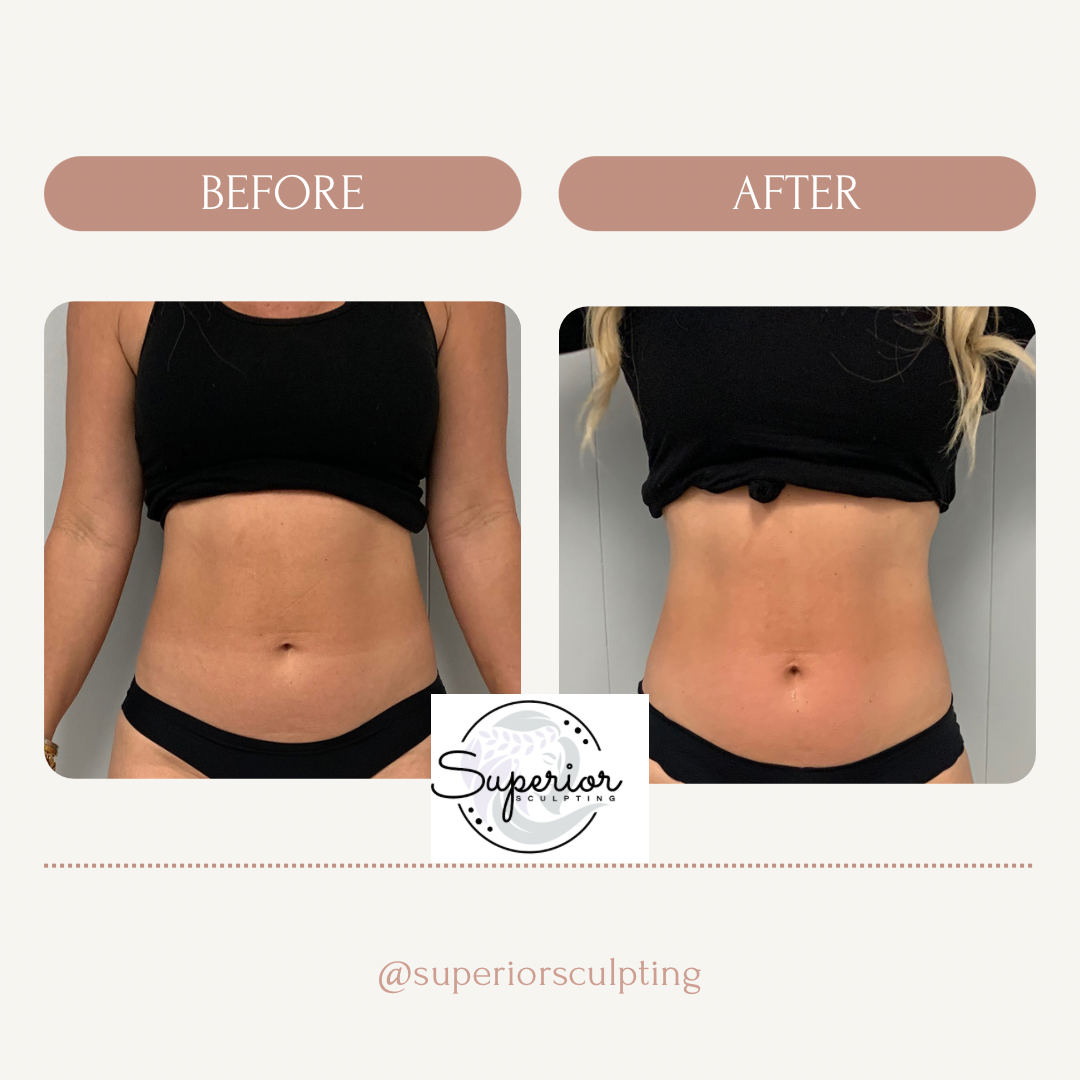 Central Beach Village body sculpting before and after